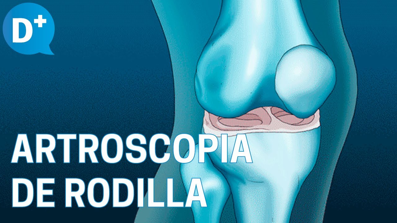 Qué es la artroscopia de rodilla Mioves